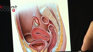 Incontinence urinaire : comment dire adieu aux couches ?
