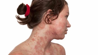 Alimentation et eczéma : un lien rare !