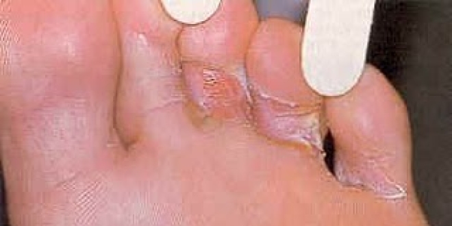 Le pied d'athlète ou mycose des pieds
