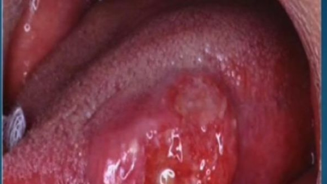 Cancer ORL : chirurgie et reconstruction