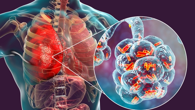 Pneumonie : comment la prévenir ?