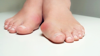Hallux valgus : tout savoir sur cette déformation du pied