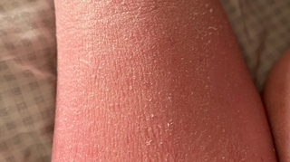 Qu'est-ce que le syndrome de la peau rouge ?
