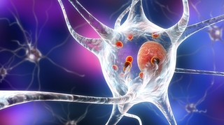 Maladie à corps de Lewy : une démence mal diagnostiquée