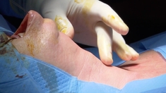 Hyperthyroïdie : une chirurgie sans cicatrice, c’est possible !