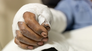 La longue convalescence des grands brûlés