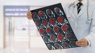 Quand l’intelligence artificielle réduit les séquelles des AVC