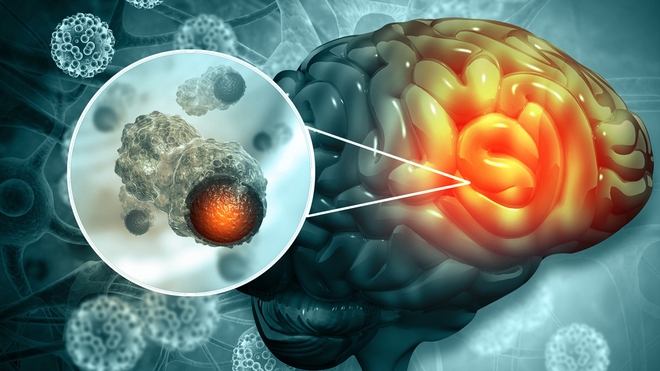 La tumeur au cerveau a empêché le patient de grandir
