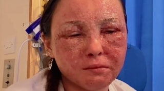 À 20 ans, elle est défigurée à cause de son eczéma