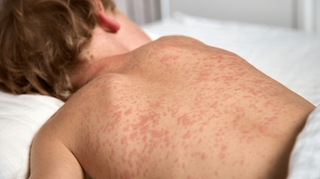 Ce qu'il faut savoir sur l'épidémie de rougeole qui a débuté dans le Rhône
