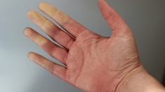 Comment soigner un syndrome de Raynaud ?