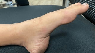 Quels sont les premiers symptômes de la maladie de Charcot ?