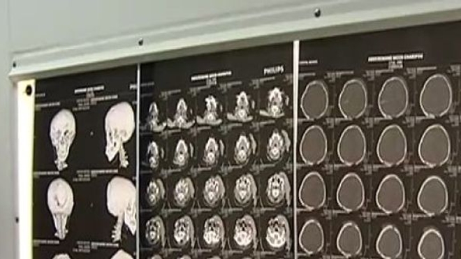 Traumatisme crânien : plus besoin de scanner ?