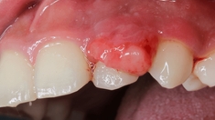 Comment soigner des granulomes dans la bouche ?